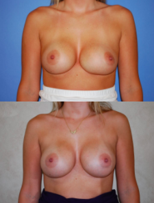 Breast Revision Patient by Dr. Lee