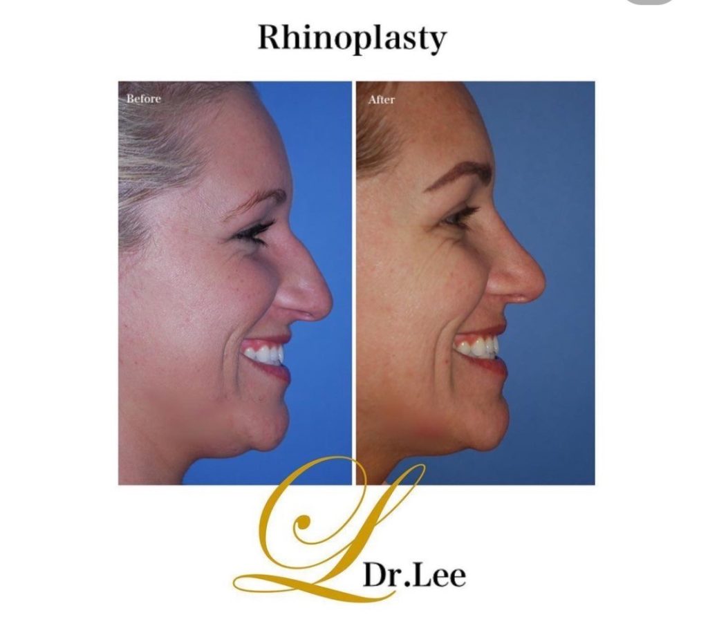 Rhinoplasty (Nose) Patient 12 - Roseville, CA | Dr. Richard K. Lee